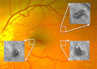 Estimation of Diabetic Retinal Microaneurysm Perfusion Parameters Based on Computational Fluid Dynamics Modeling of Adaptive Optics Scanning Laser Ophthalmoscopy